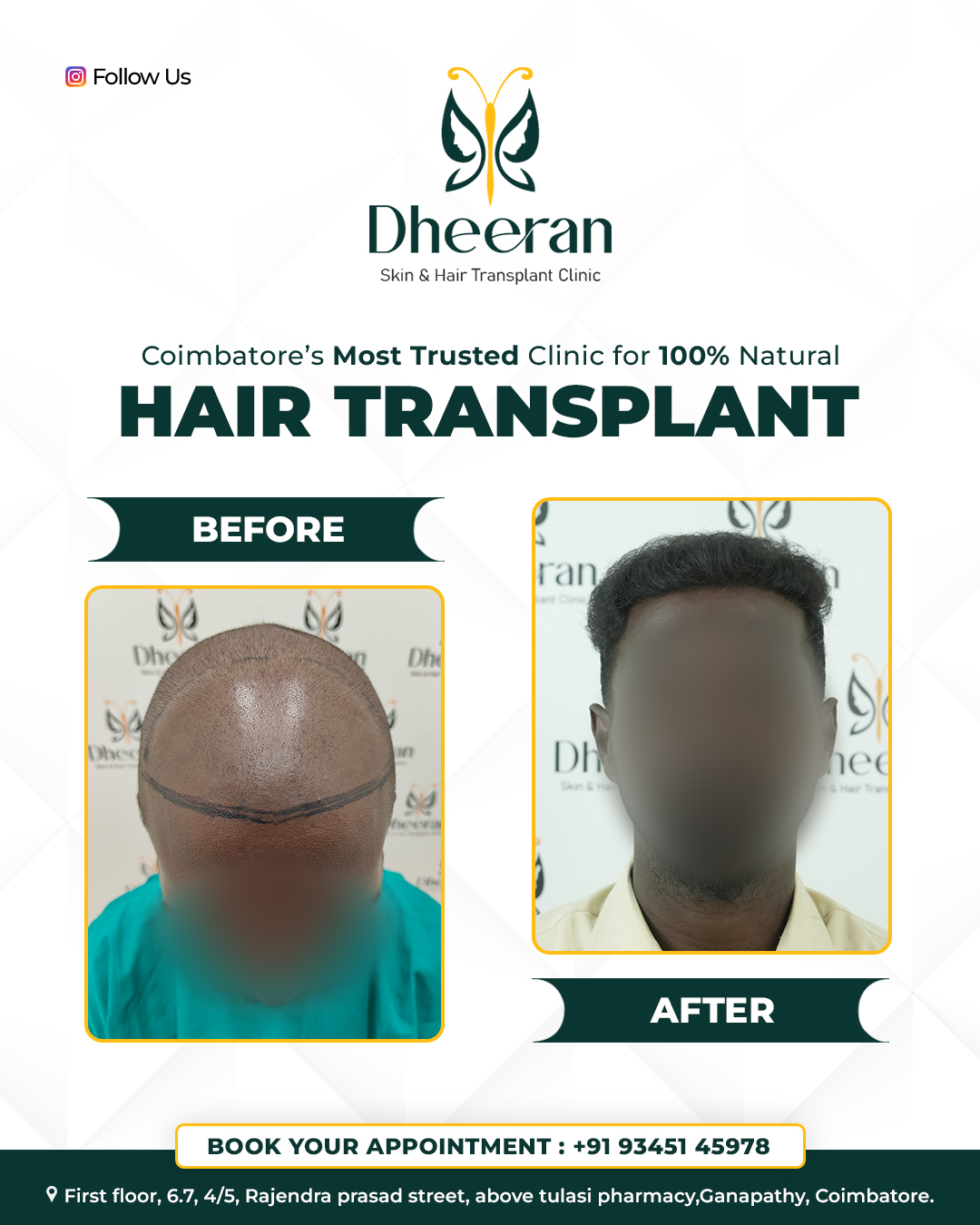 01 - Aakash Before After