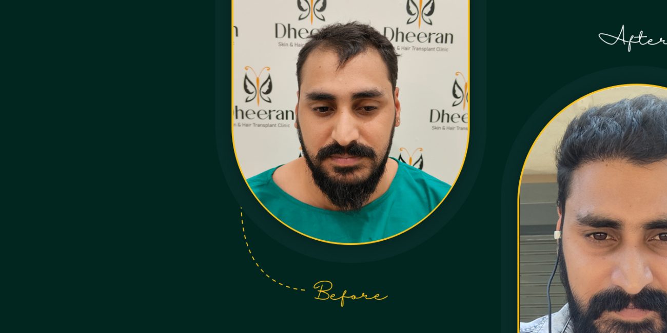 Hairline correction surgery by Dr. Vivin Prasadh - Dheeran Clinic Coimbatore