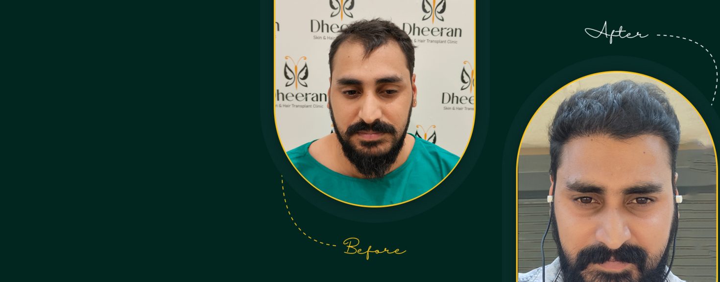 Hairline correction surgery by Dr. Vivin Prasadh - Dheeran Clinic Coimbatore