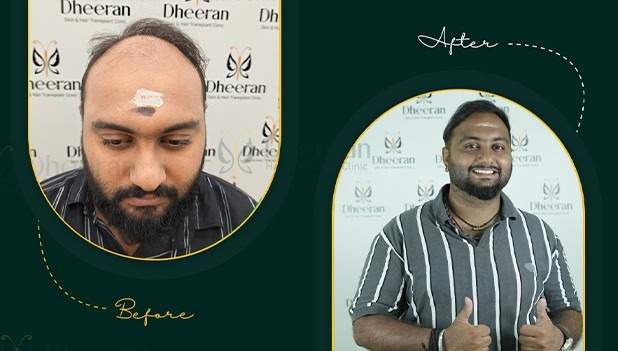 Best Hair Transplant Clinic Coimbatore