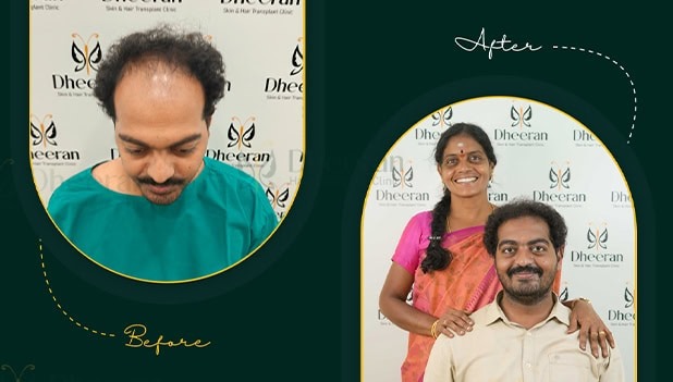 Hair Transplant Results Coimbatore