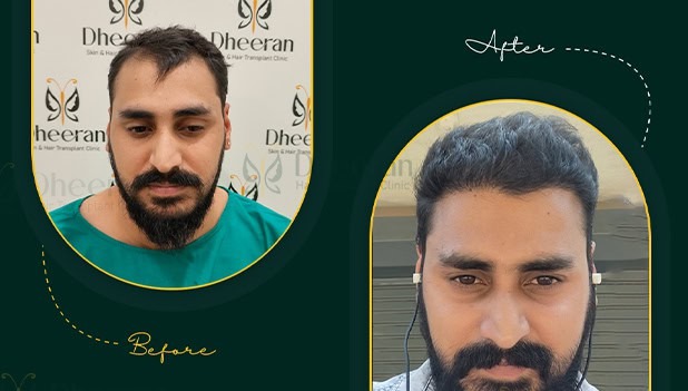 FUE Hair Transplant Coimbatore