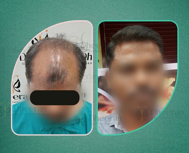 Hair Transplant Coimbatore 4200 Grafts