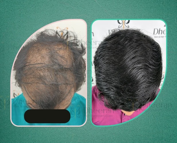 Hair Transplant Salem 4300 Grafts