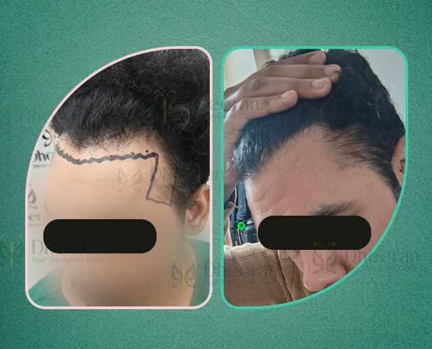 Hair Transplant Trichy 1800 Grafts