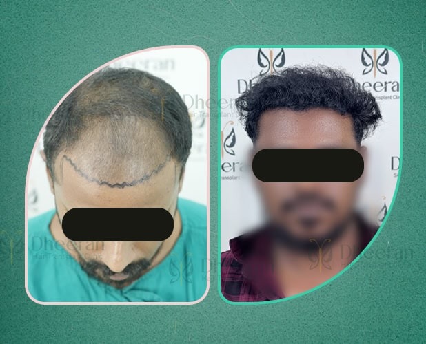 Hair Transplant Madurai 4200 Grafts