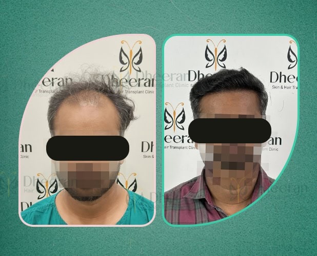 Hair Transplant Chennai 4000 Grafts