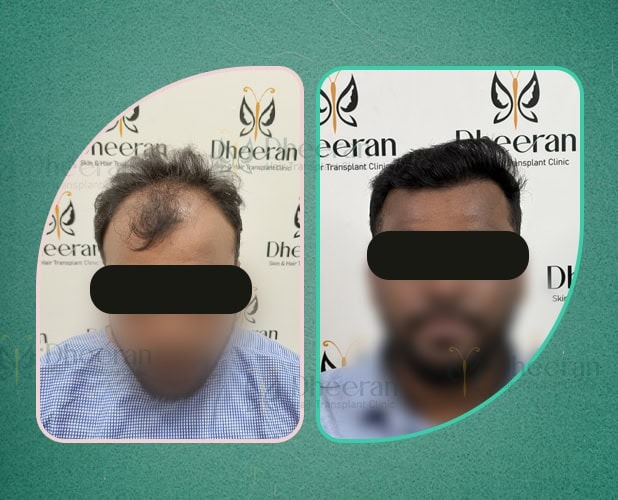 Hair Transplant Theni 3800 Grafts
