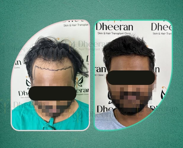 Hair Transplant Coimbatore 3400 Grafts