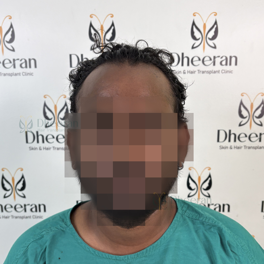 hairtransplant_chennai (2)