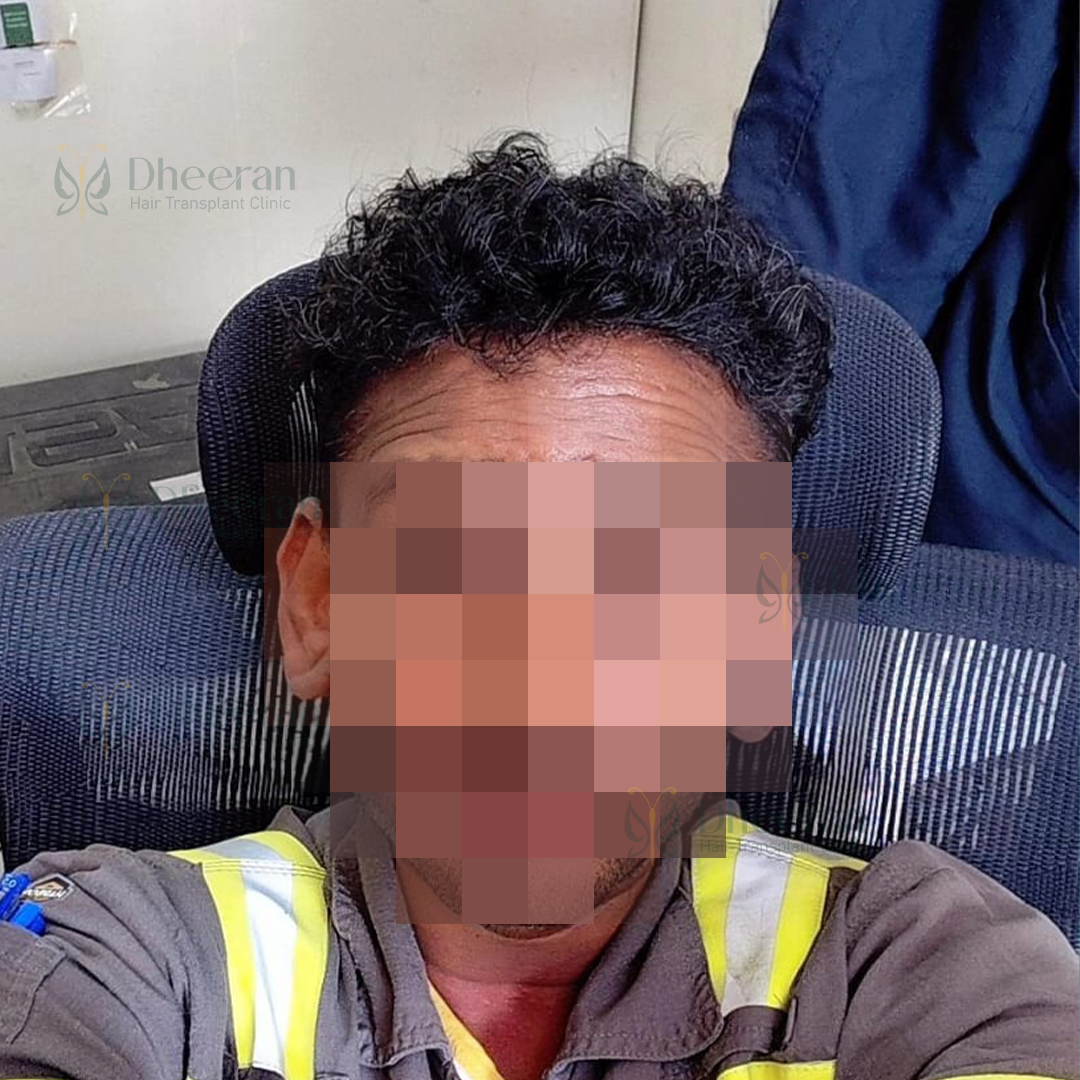 hairtransplant_chennai (4)