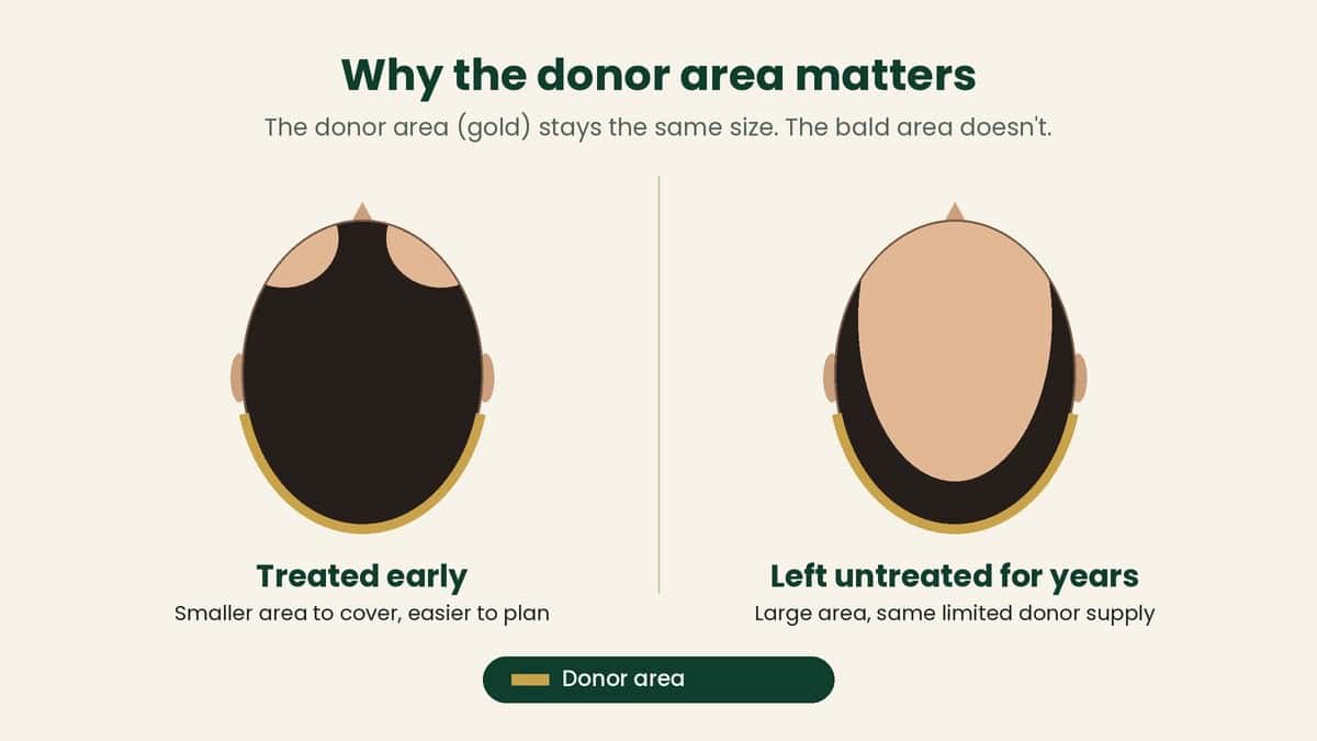 Comparison of the donor area at the back and sides of the scalp with a small bald area treated early versus a large bald area after years without treatment