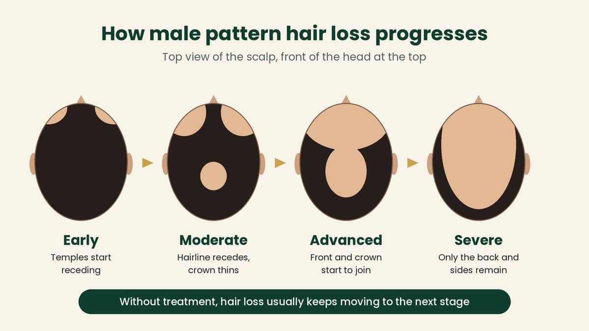 Male pattern hair loss stages that progress without hair fall treatment, from early temple recession to severe baldness