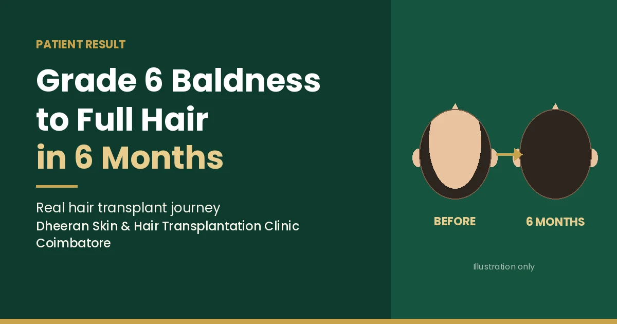 Grade 6 baldness to full hair in 6 months – hair transplant result at Dheeran Clinic Coimbatore