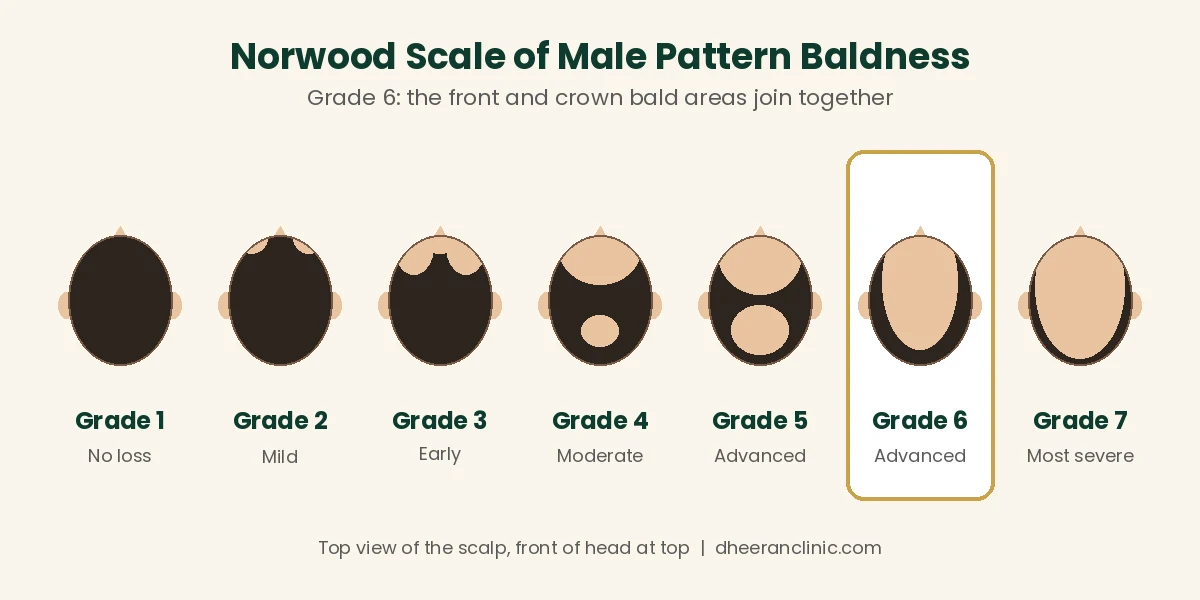 Norwood scale of male pattern baldness showing Grade 1 to Grade 7, with Grade 6 highlighted
