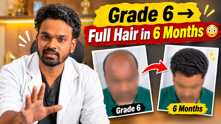Grade 6 Baldness to Full Hair in Just 6 Months: A Real Hair Transplant Journey