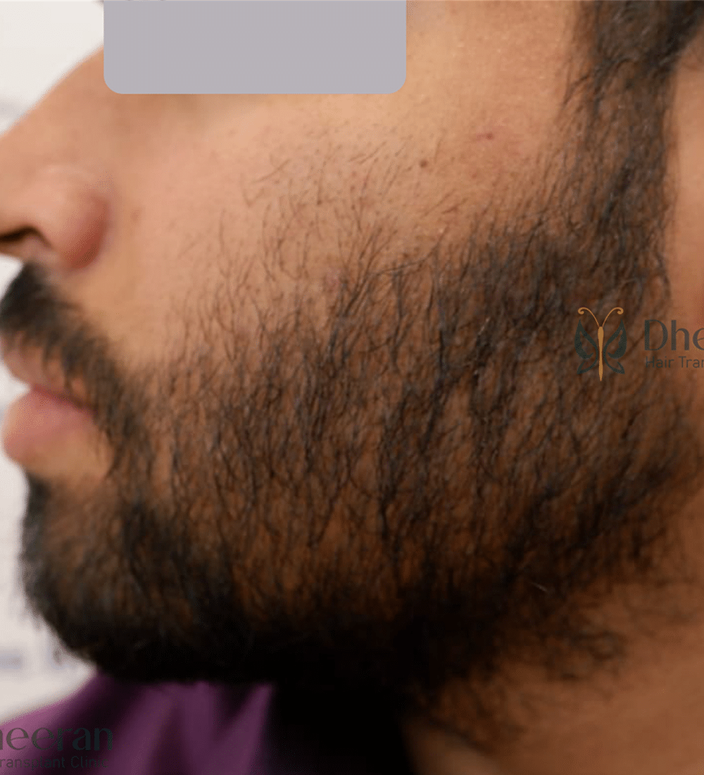 Beard transplant result at Dheeran Clinic