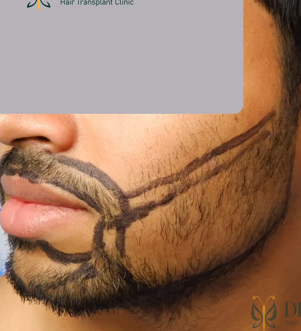 Before beard transplant