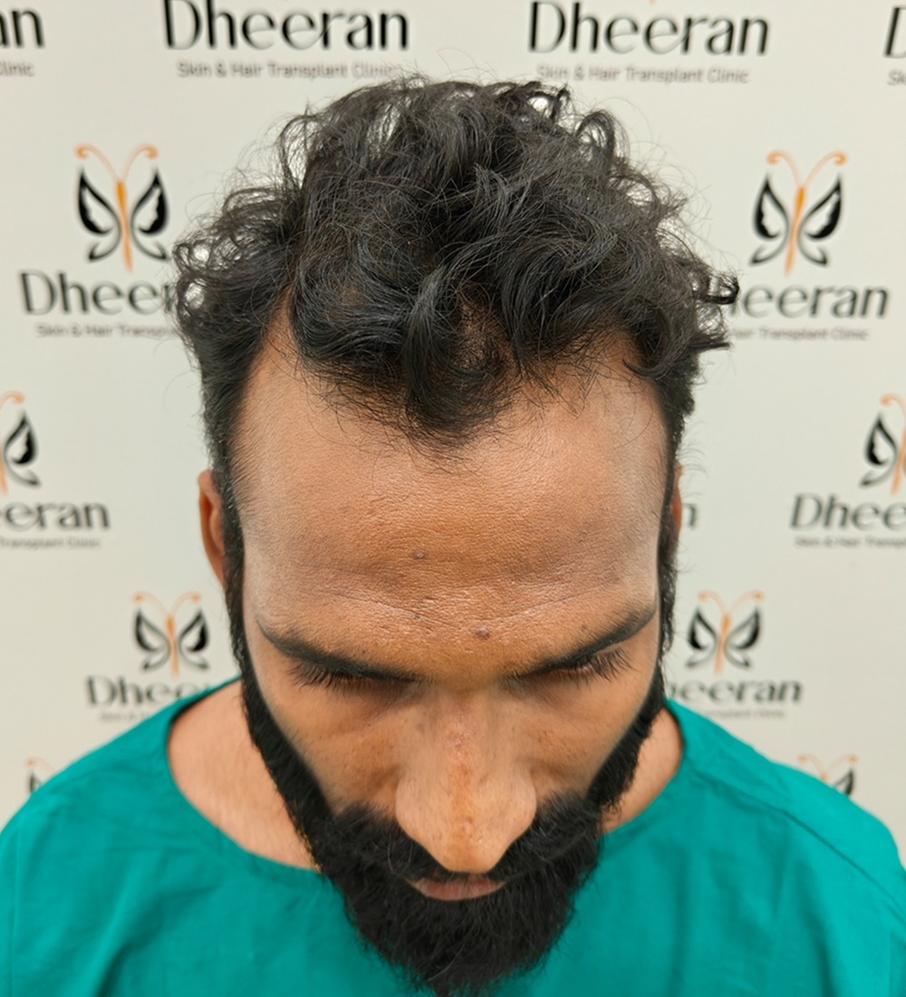 Before hairline correction