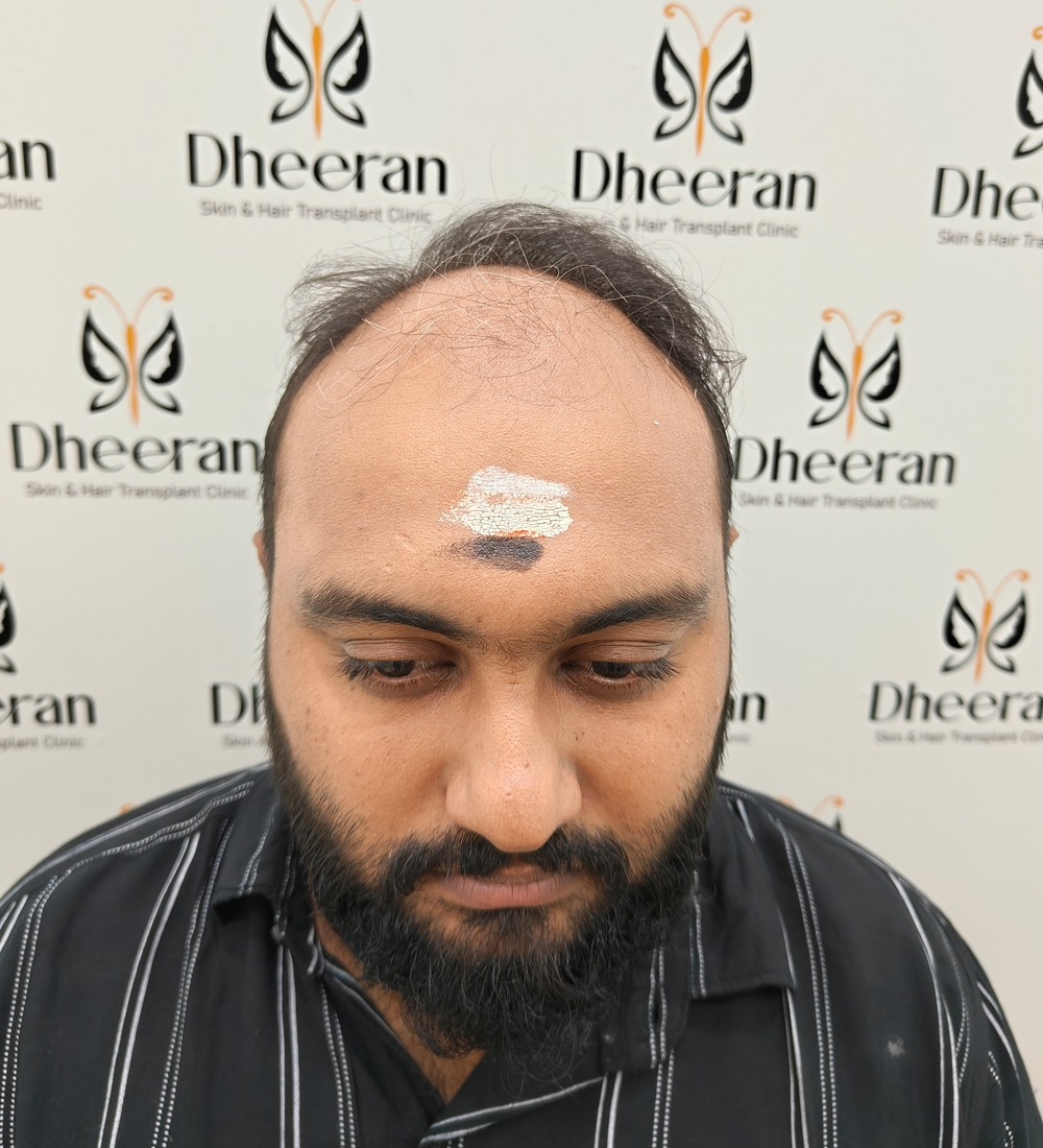 Before hair transplant