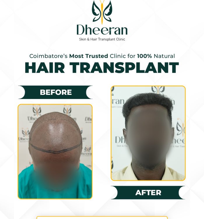 01 - Aakash Before After