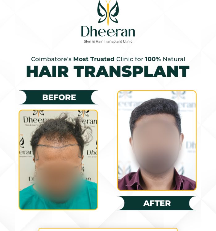 02 - Boobalan Before After