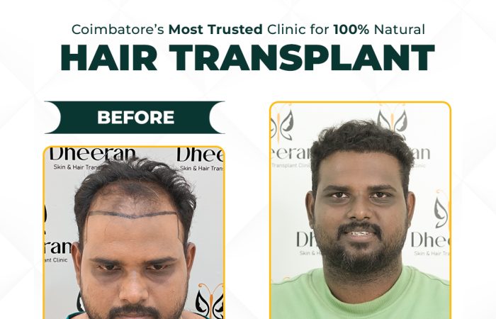 03 - Manikandan Before After