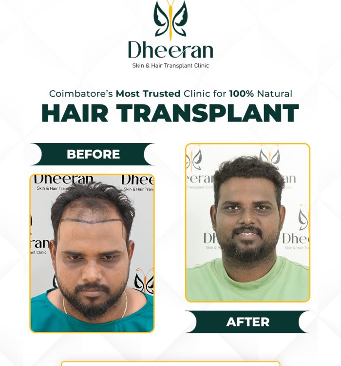 03 - Manikandan Before After
