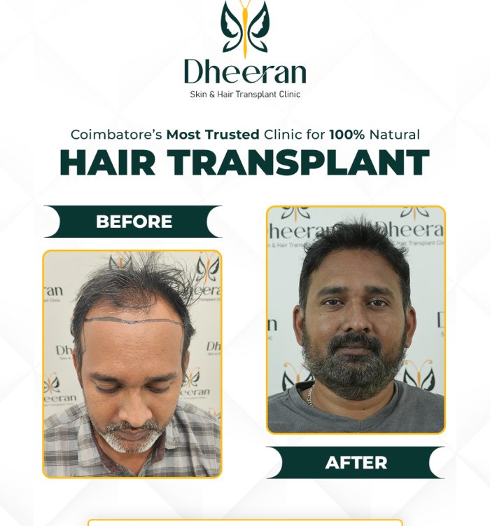 04 - Selam Before After