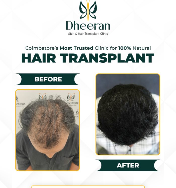 08 - Prem Before After