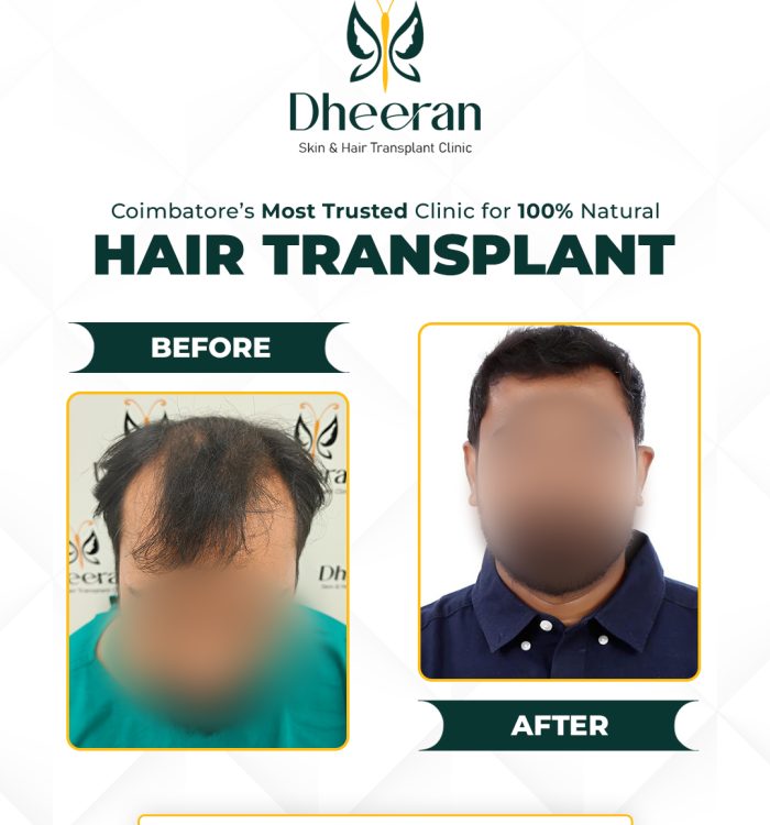 10 - Suresh babu Before After
