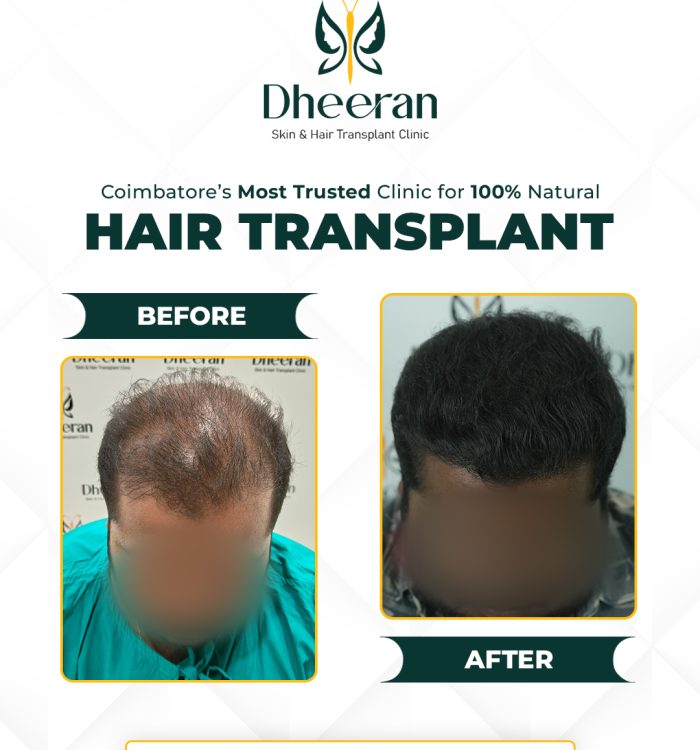 11 - Vignesh Before After